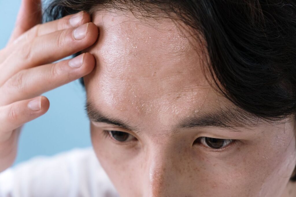 Close-up of a sweaty forehead