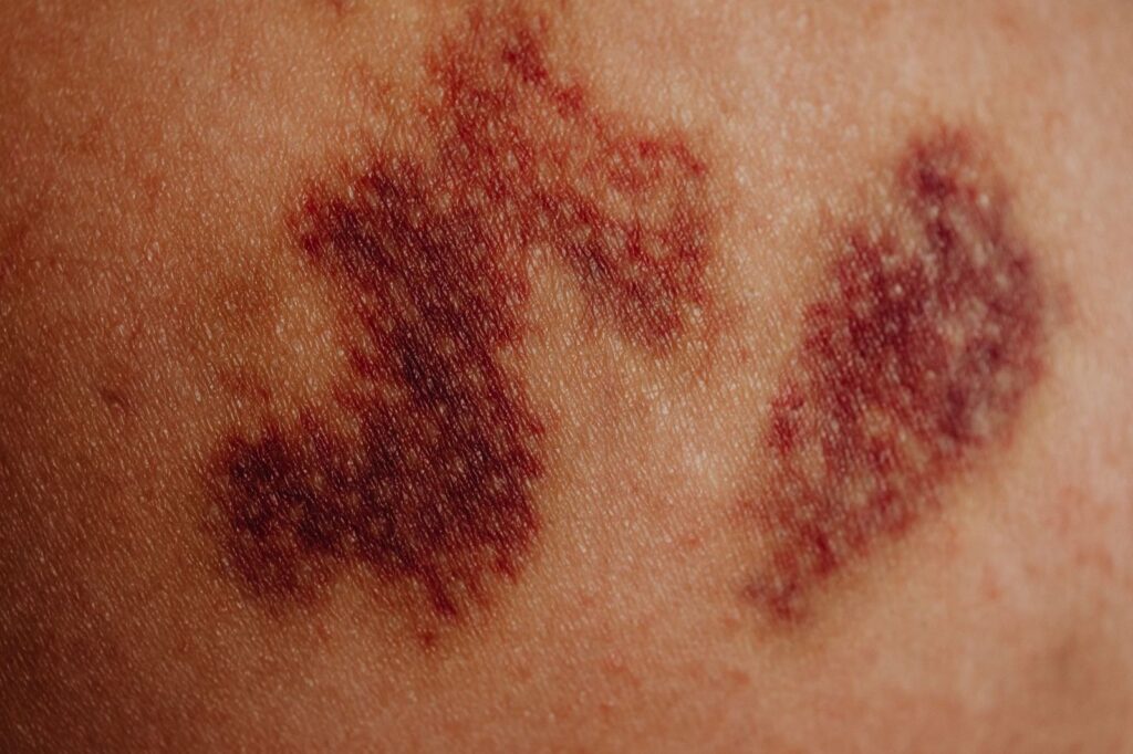 Close-up of a bruise on skin
